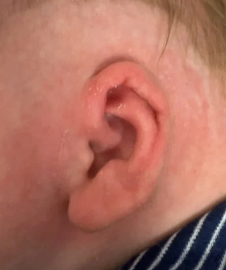 EarWell System case #17154