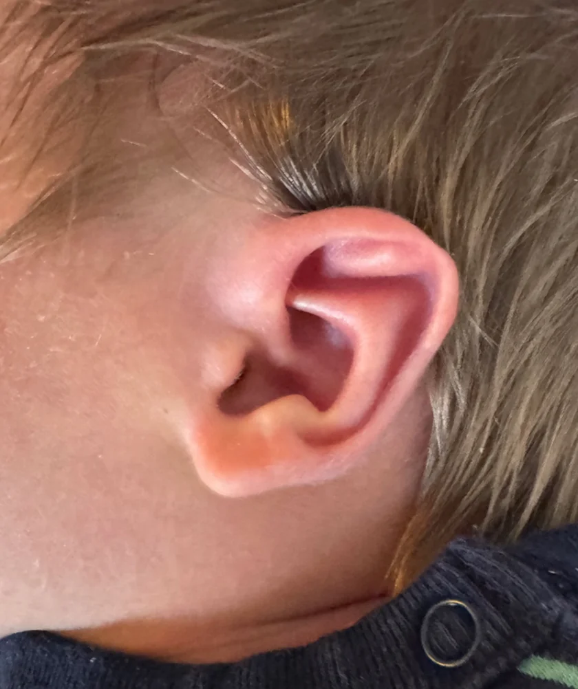 EarWell System case #17155