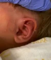 EarWell System case #17155