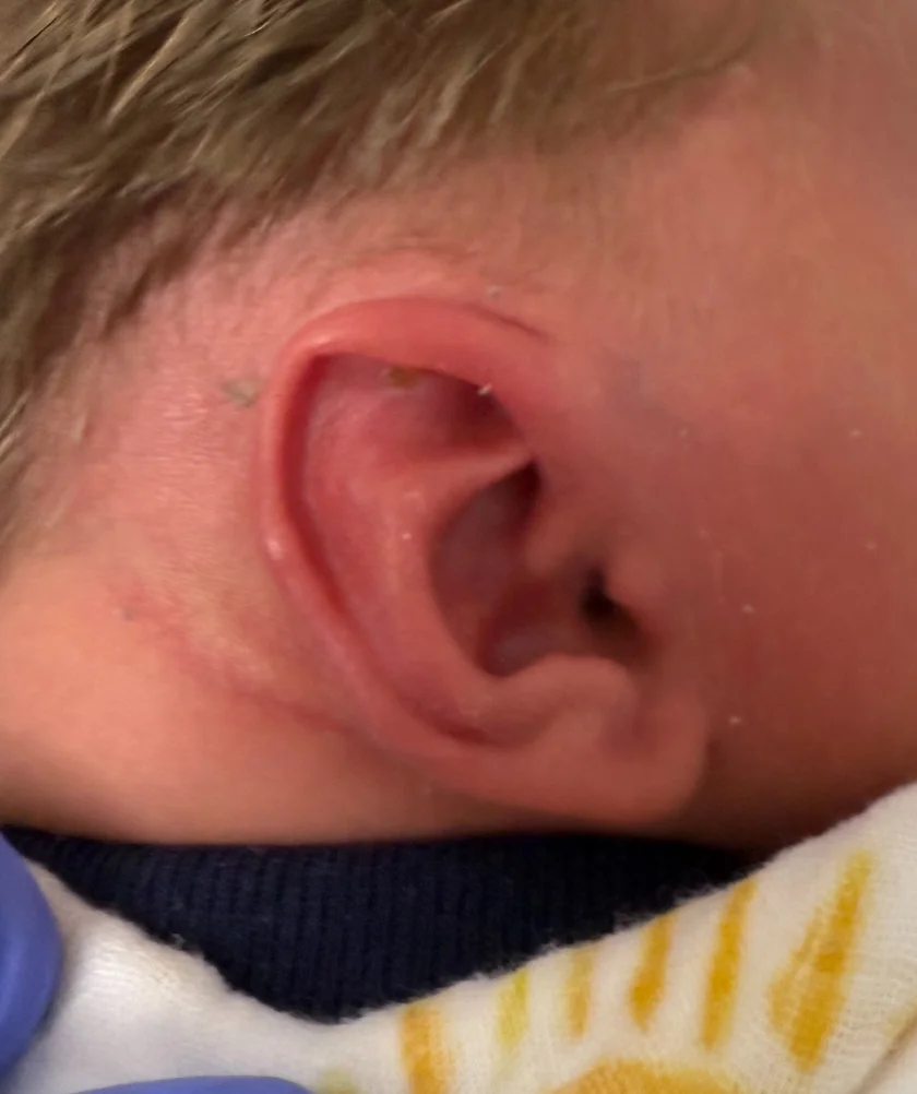 EarWell System case #17155