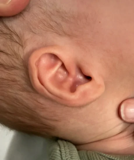 EarWell System case #17156
