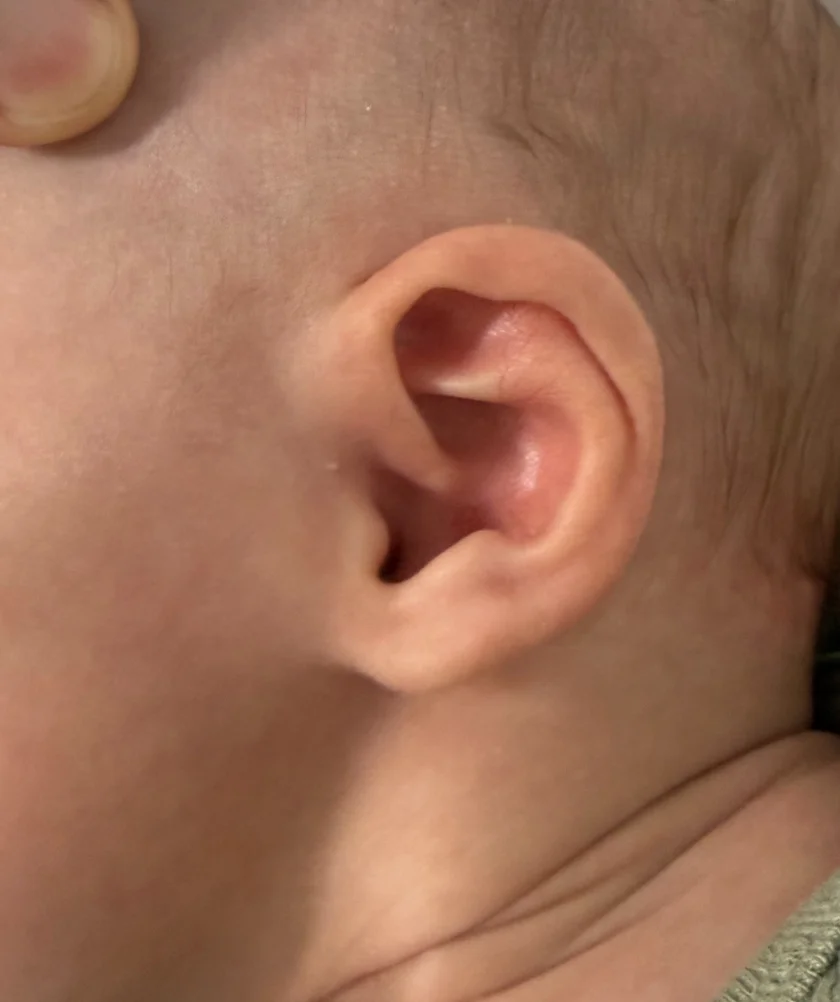 EarWell System case #17156