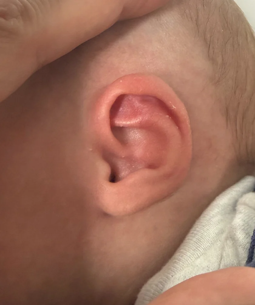 EarWell System case #17156