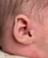 EarWell System case #17157