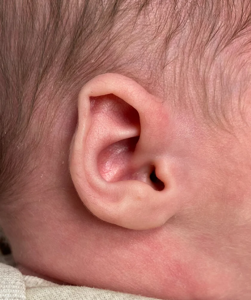 EarWell System case #17157