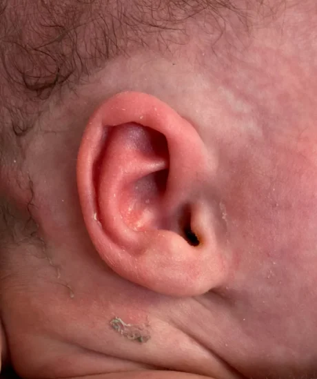 EarWell System case #17157