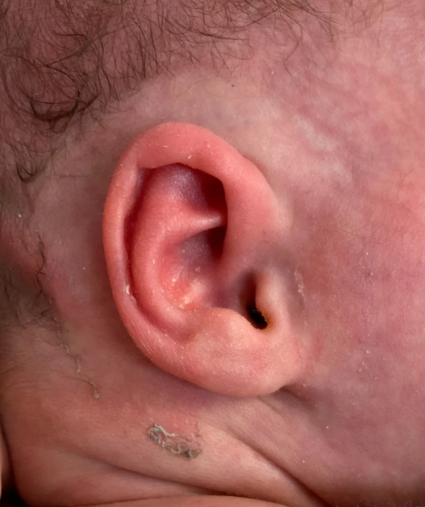 EarWell System case #17157