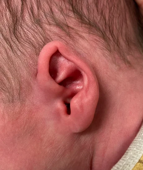 EarWell System case #17157