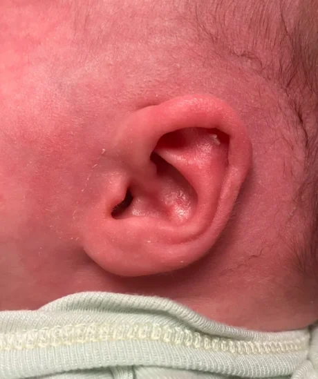 EarWell System case #17157